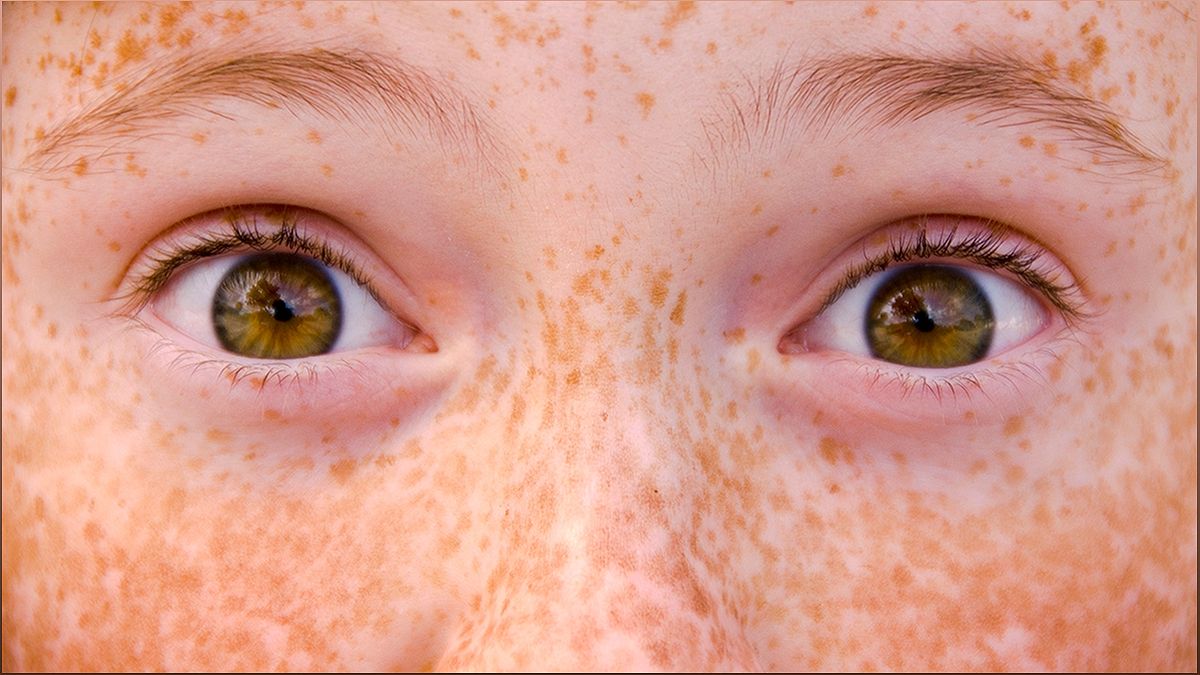 Understanding Freckles: Causes, Significance, and Sun Protection - -828850323